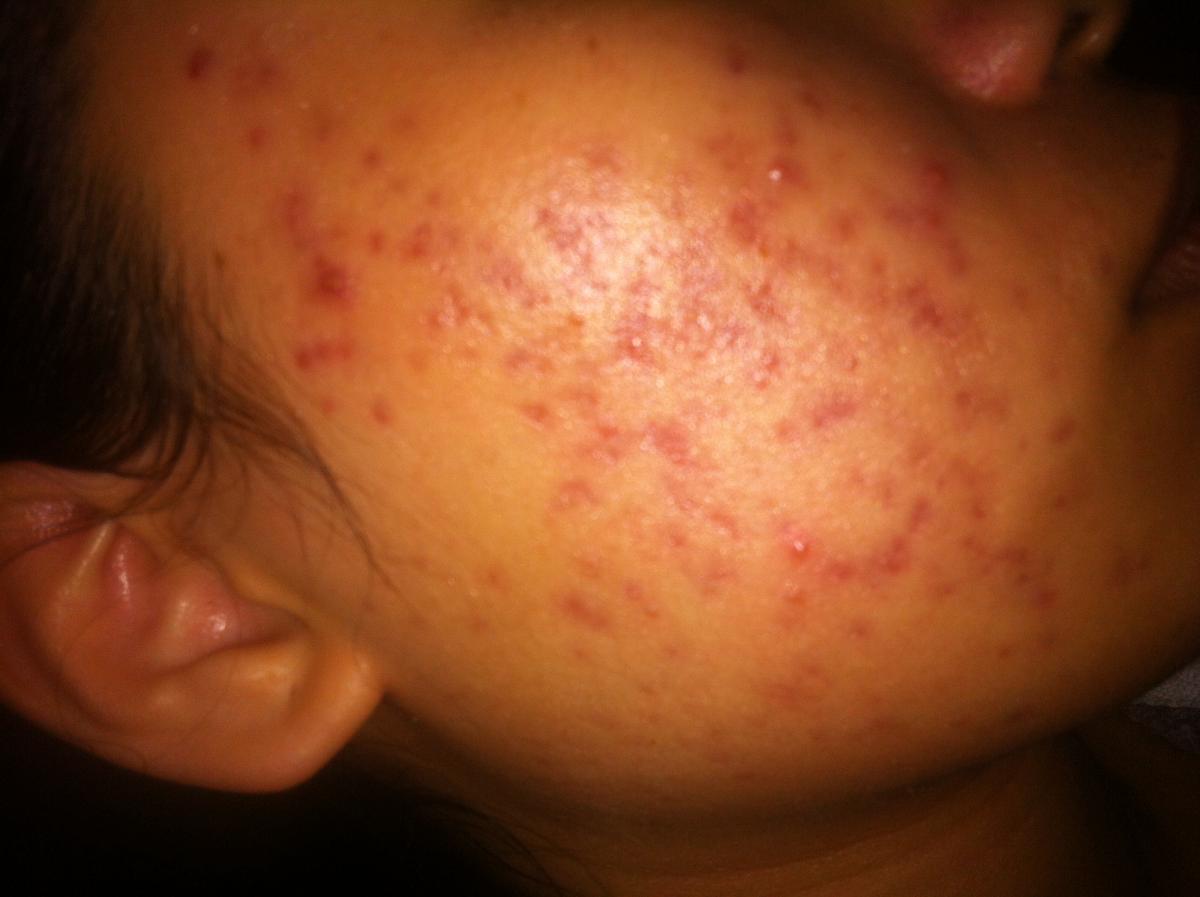 Type And Cure For Lots Of Acne Scars Covering My Cheeks! (With Pic