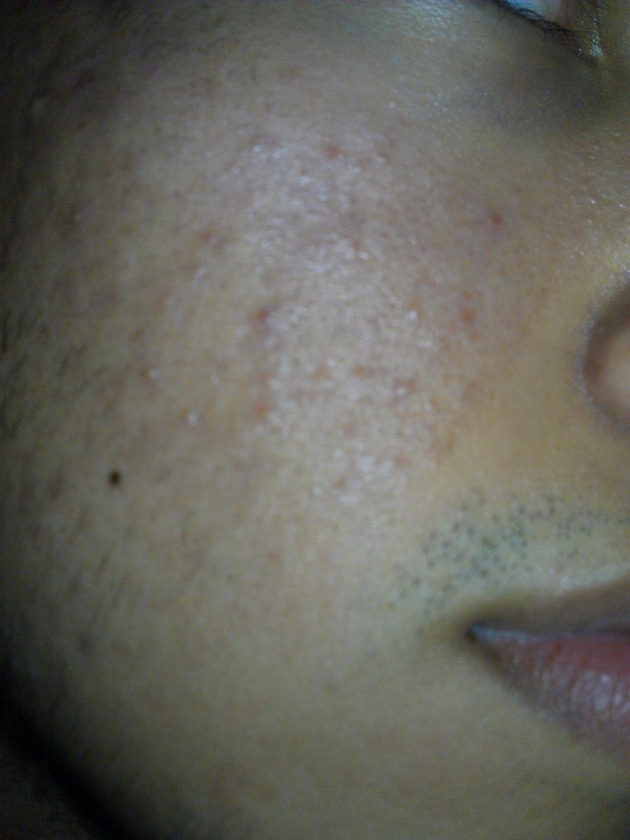 Make Acne Go Away? It Only Shows Up Close? (Pictures Included ...