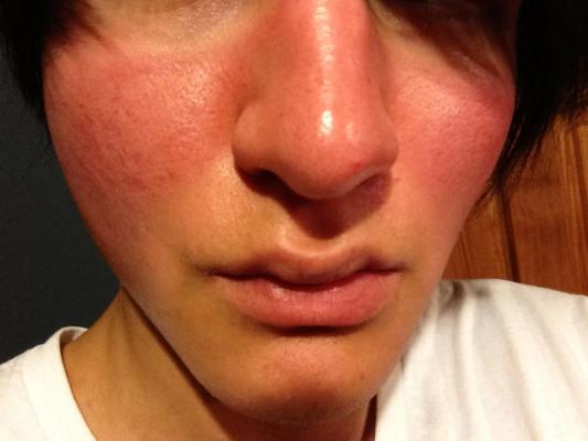 sunburn and acne scars