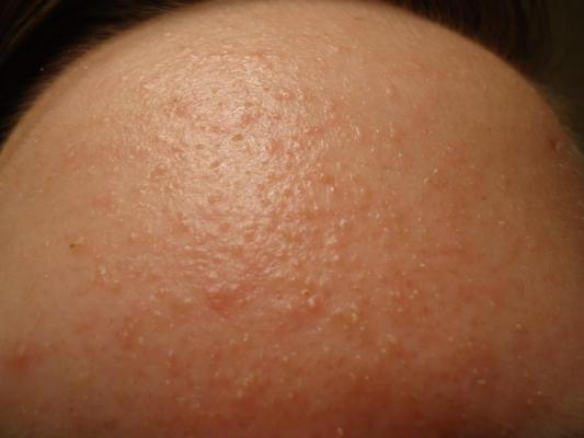 Strange Acne Rash On Forehead General Acne Discussion