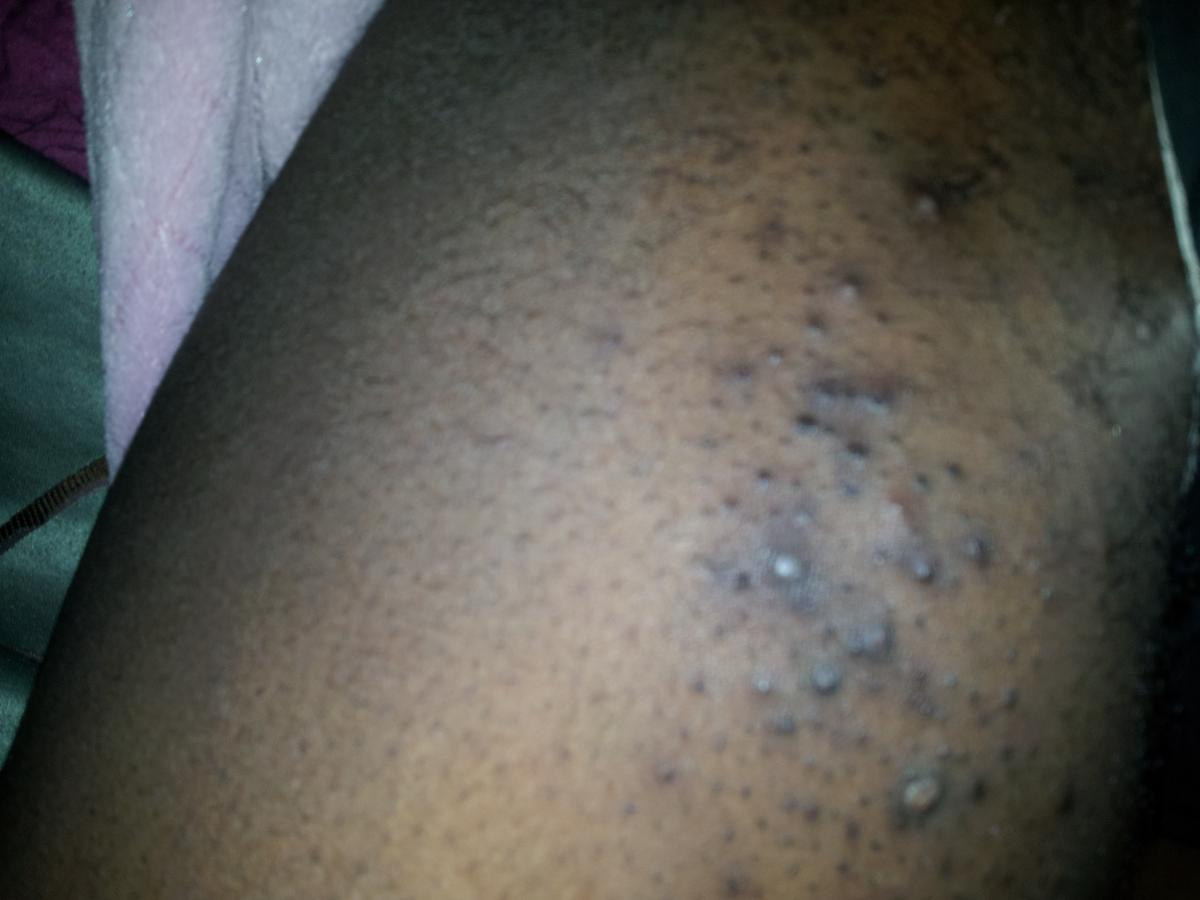 Acne Between My Inner Thighs - Back/Body/Neck acne - Acne.org Community