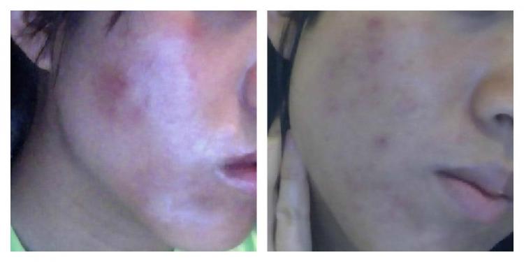 Amazing Nutritional Supplements That Helped My Skin Photos Diet Holistic Health Acne Org