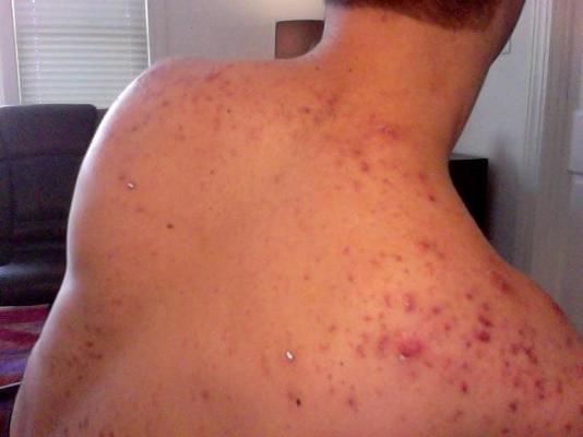 back acne scars