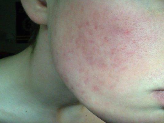Skin red after accutane blotchy
