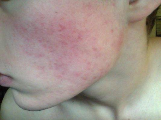 accutane after prescription