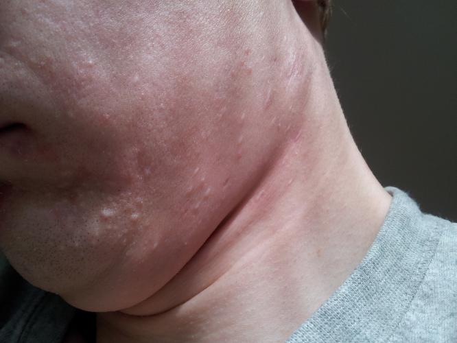 What Are These White Lumps Pictures General Acne Discussion