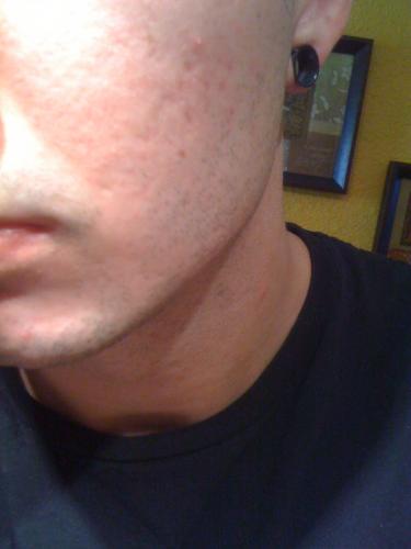how to get rid of red marks from acne scars naturally