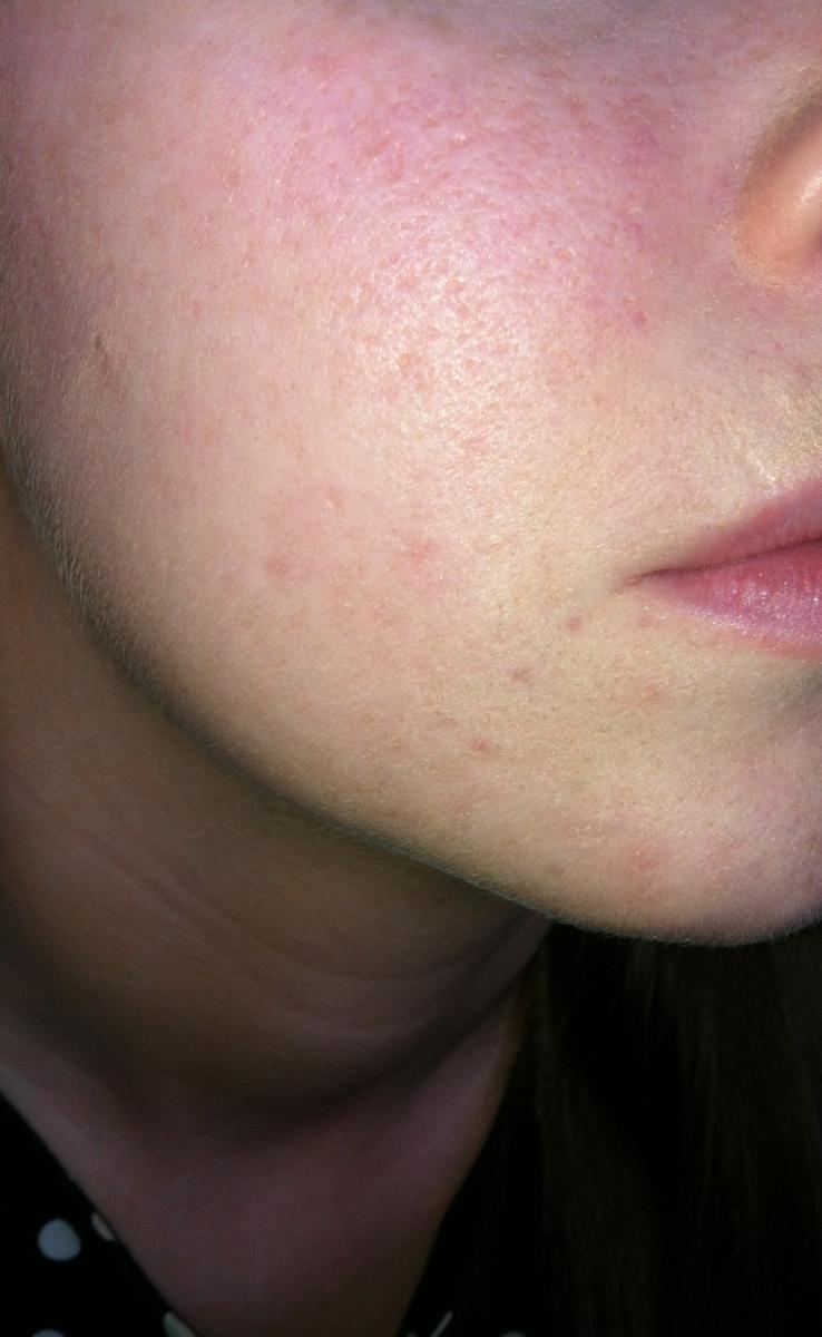 skin acne scars treatment at home