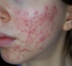 Severe Acne On Face - Won't Go Away. - General acne discussion - by
