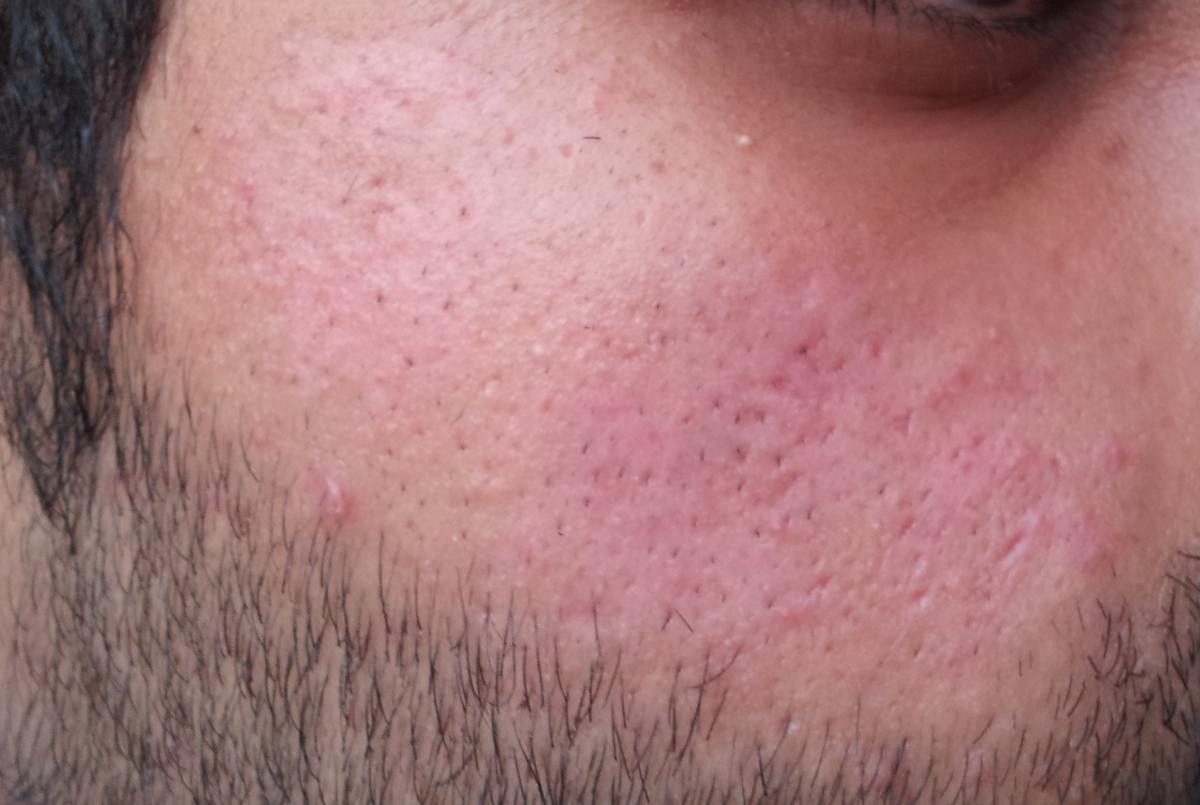 How To Solve My Redness, Pores, And Scars. Recell Maybe? (Pics Included