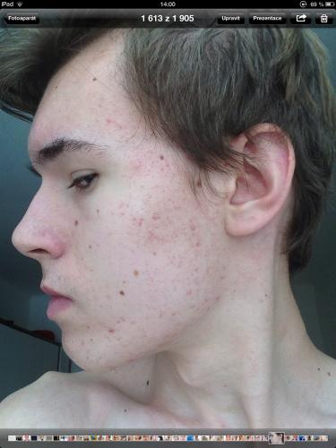 Accutane Journey Mild Acne General Acne Discussion By Rolileisztner Community