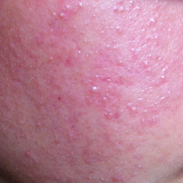 Whiteheads All Over My Face - General acne discussion - Acne.org Community