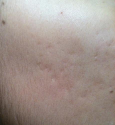 Help Me Identify These Scars Please – Scar treatments – Acne.org Forum