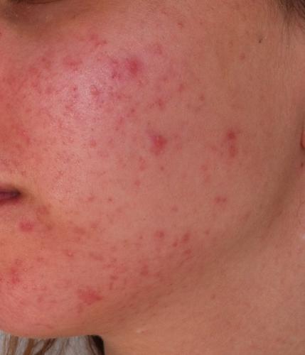 Small Bumps All Over My Face, Help Please :( +Pics - General acne ...