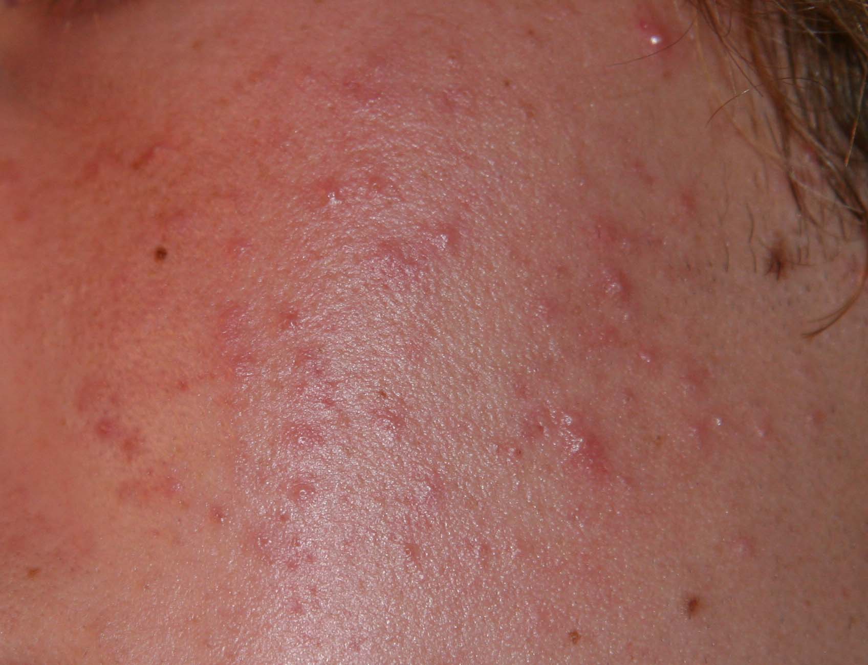 Are little red bumps red marks or pimples? - The Acne.org Regimen ...
