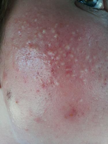 Male 22 First Time Accutane Accutane isotretinoin logs Acne