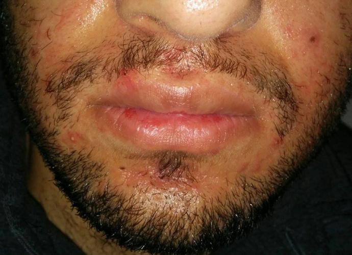 folliculitis dermatitis hormonal perioral cystic cluster