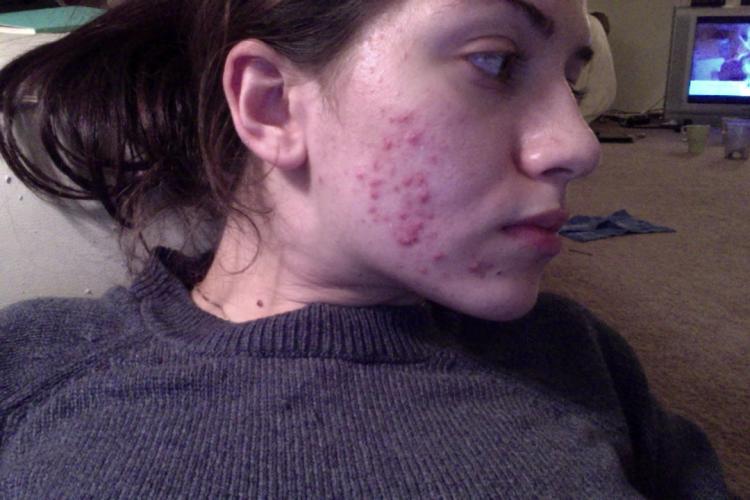 Minocycline And Clindamycin Topical Gel - Personal logs - Acne.org
