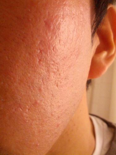 Need Recommendation For Acne Scar/orange Peel Texture! (Pics Included