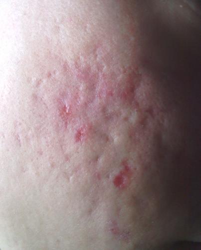 How Bad Are My Scars – Scar treatments – Acne.org Forum