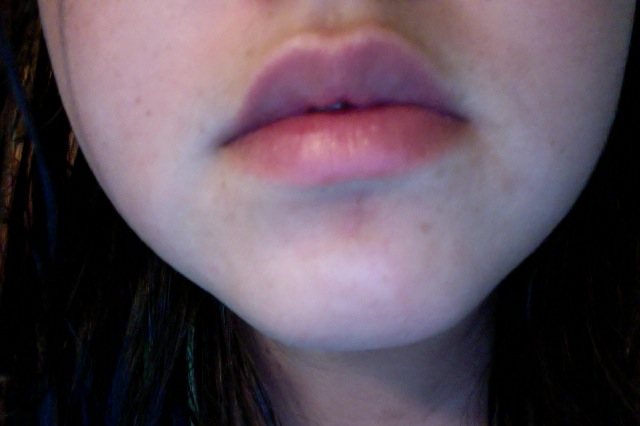 Brown Mark On Chin, Please Help – Scar treatments – Acne.org Forum