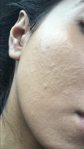 Will Retin A Work To Improve Skin Texture And Bumps Prescription Acne Medications Acne Org