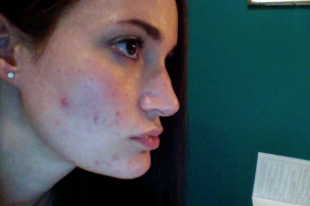 acne help hormonal does accutane