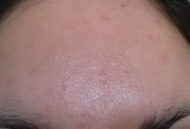 Acne/rash Overnight. Yasmin Or Don Quai To Blame? Can This Happen ...