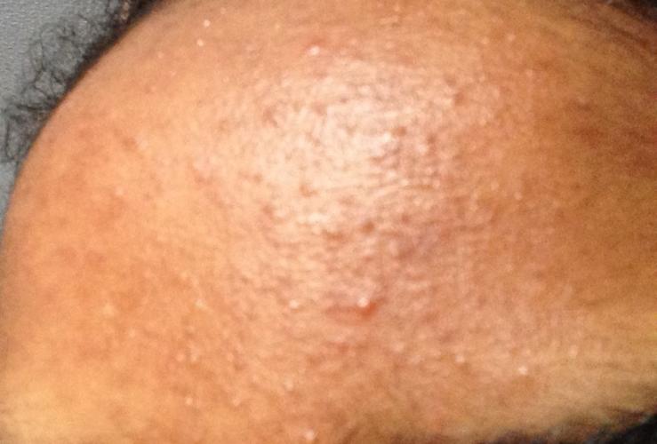 Weird Texture On Forehead And Strange Bumps General Acne Discussion