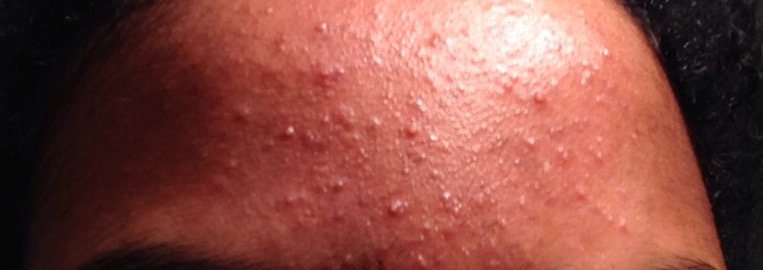 Weird Texture On Forehead And Strange Bumps General Acne Discussion