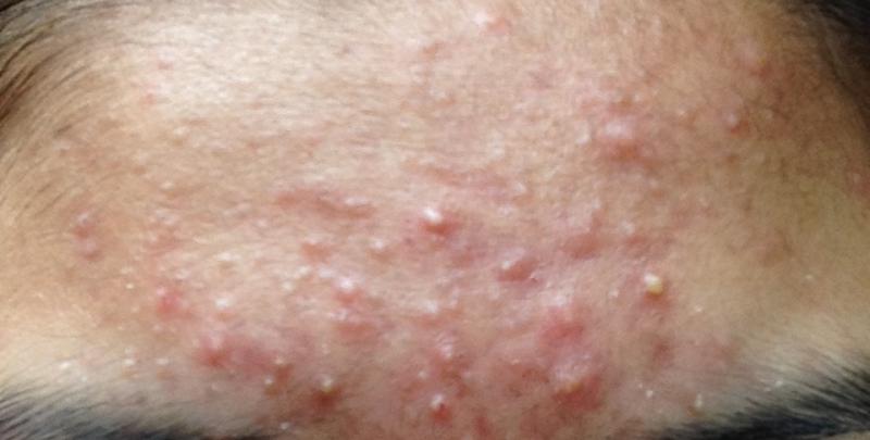 Is It Acne Or Pityrosporum Folliculitis With Pic General Acne Discussion By Anjanjxo