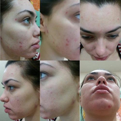 of days side effects 5 missed accutane