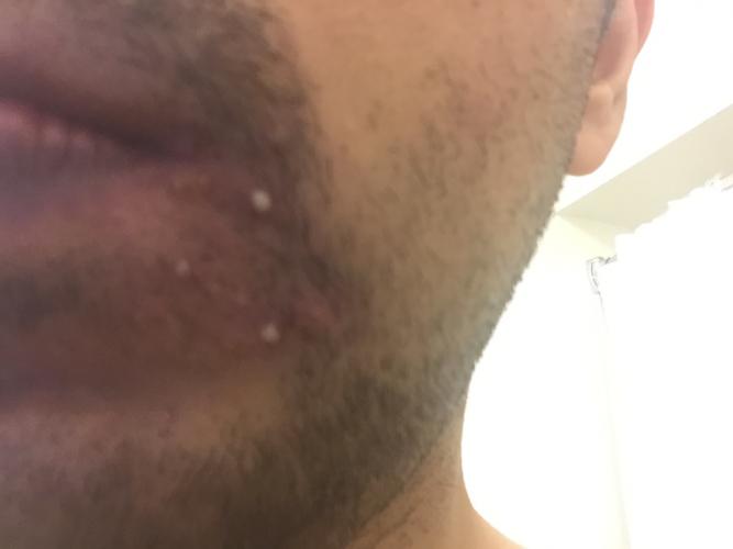 HElP!! A pimple keeps filling up with pus - General acne discussion