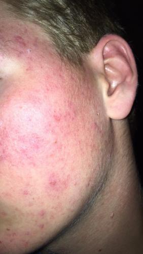 Accutane low 10mg dose