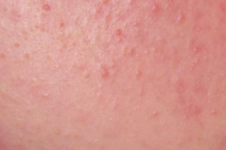 Facial Keratosis Pilaris - Over-the-counter acne ...