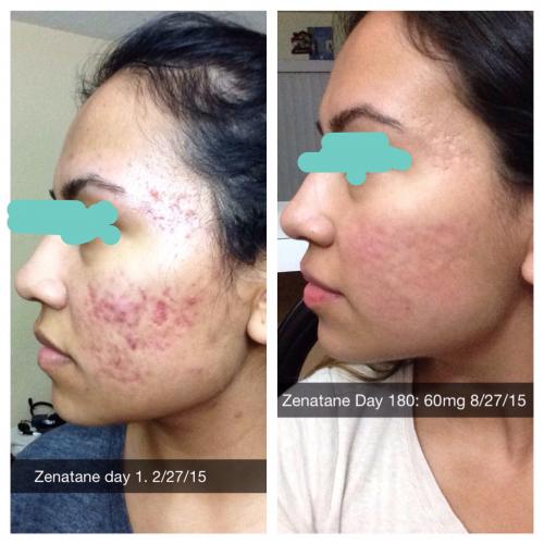 Price accutane acne medication