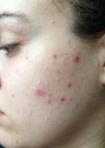 acne-out-of-nowhere-adult-acne-acne-forum