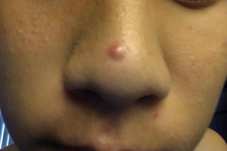 I Popped A Pimple And Now I Ended Up With This Please Help General Acne Discussion Acne 2244