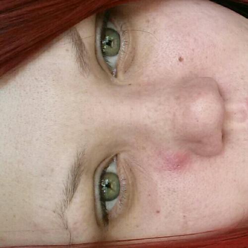 Huge Red Lump Next To Nose Please Help General Acne Discussion Acne 9205