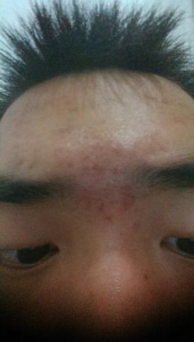 Brown Acne Marks Between Eyebrows - Scar treatments - Acne.org