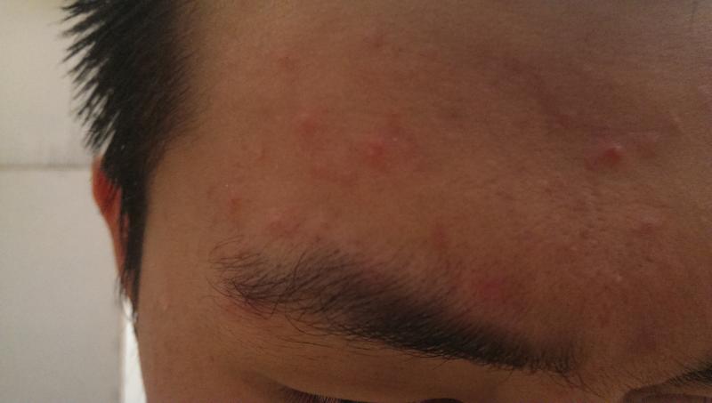 Bumps On Forehead General Acne Discussion Forum 9280