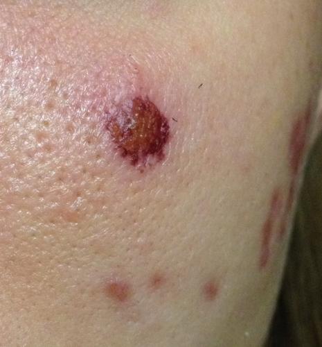 Help! Squeezed Too Hard – Tissue Slipped Left A Huge Scab. – Skin – Acne.org Forum