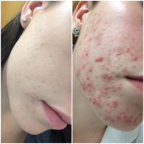 I Cleared My Acne After I Stopped The Regimen - General acne discussion