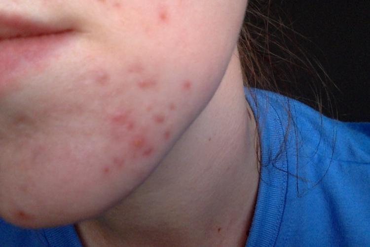 hormonal-acne-won-t-go-away-please-please-help-hormonal-acne