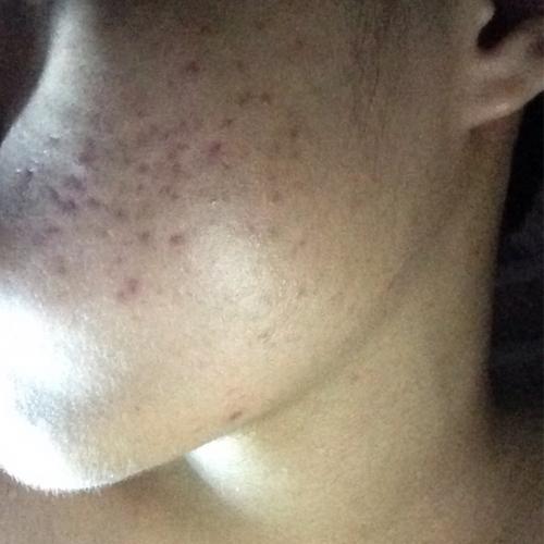 tips-on-curing-my-acne-general-acne-discussion-acne-forum