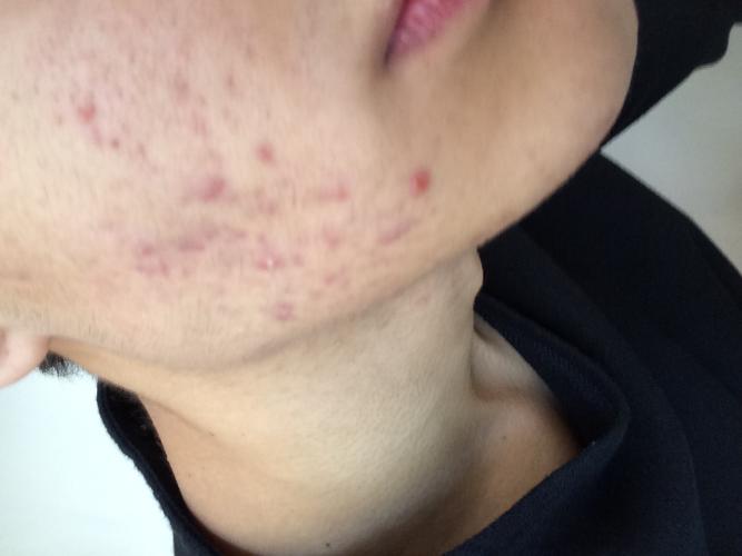 why-is-my-skin-so-red-scar-treatments-acne-forum