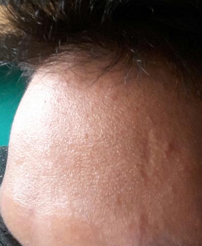 How Can I Get Rid Of These Little Bumps On My Forehead General Acne Discussion Forum 5378