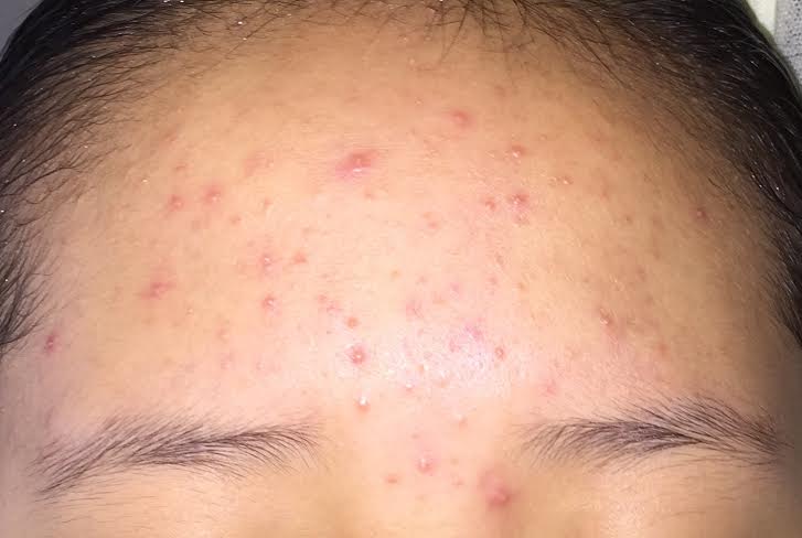 Oily T Zone Clogged Pores Or Pityrosporum Folliculitis Pics