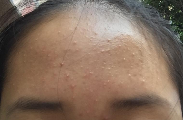 folliculitis forehead