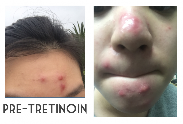 My Tretinoin (0.1%) Weekly Log W/ Pictures! - Personal logs - by